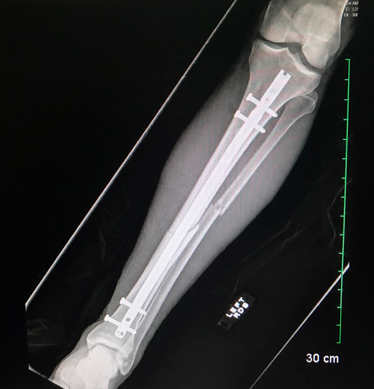 Robby Albarado arm xray